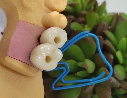 تاج زراعة الأسنان الباطنية