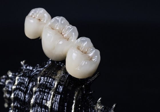 الإطار المعدني PFM Dental Crown
