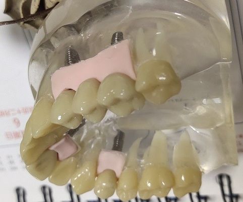 100 بالمائة التوافق الحيوي PMMA التاج المؤقت