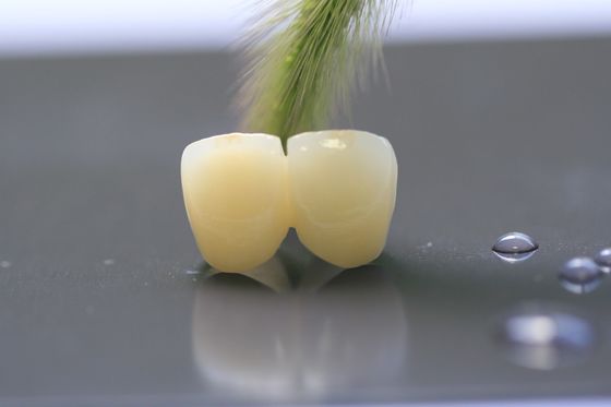 إطار الطباعة ثلاثية الأبعاد PFM Dental Lab Crown لطب الأسنان
