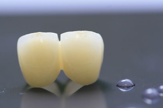 إطار الطباعة ثلاثية الأبعاد PFM Dental Lab Crown لطب الأسنان