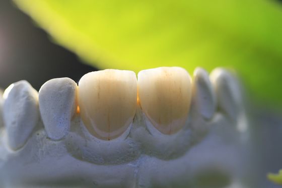 إطار الطباعة ثلاثية الأبعاد PFM Dental Lab Crown لطب الأسنان