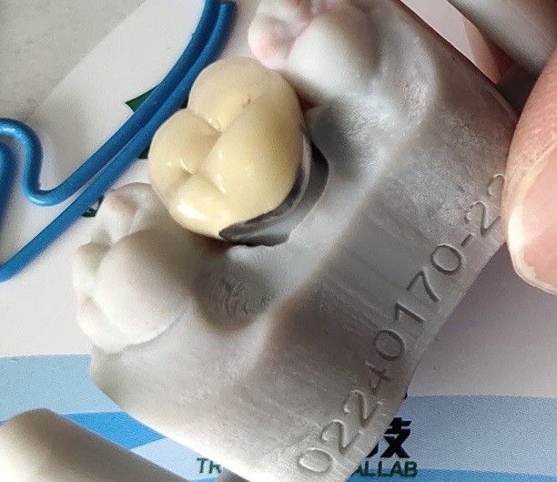 الأسنان مختبر المنتج CAD CAM PFM Crown الخزف المنصهر في المعدن